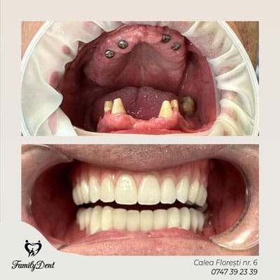 Rezultat caz Proteză fixă pe 4 implanturi rezultat Family Dent Cluj