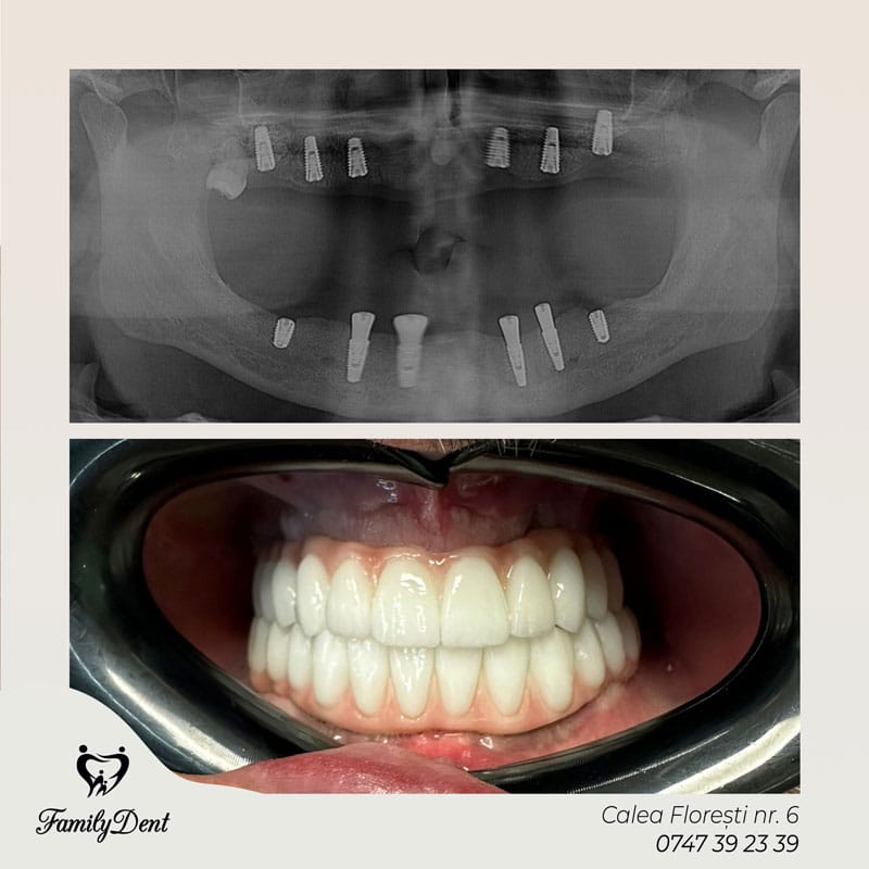 Implant dentar digital Family Dent Cluj - Cabinet stomatologic Calea Floresti