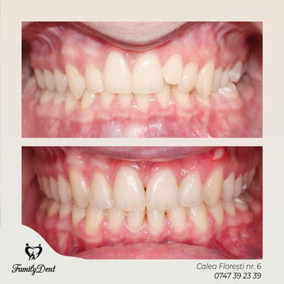 Rezultat aparat dentar metalic Cluj: Corectare înghesuire dentară severă și aliniere perfectă la Family Dent