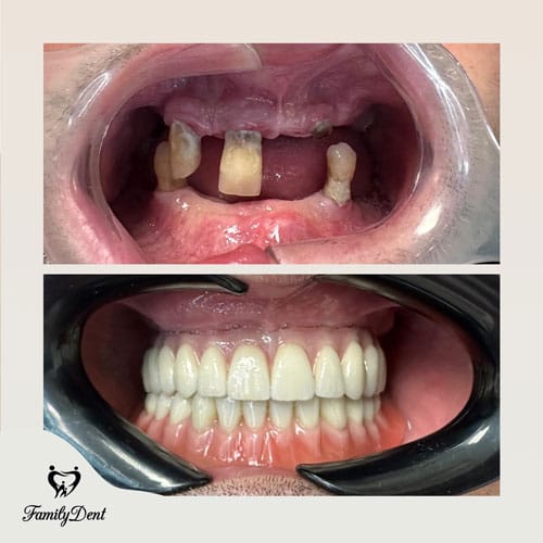 implant dentar cluj, all-on-6 cluj, proteza fixa cluj, proteza pe implanturi cluj