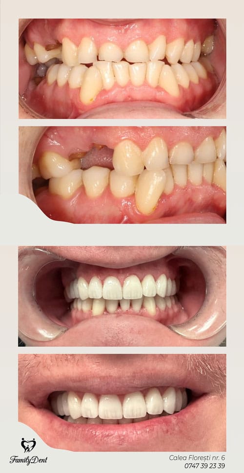 aparat dentar cluj, implant dentar cluj, fatete dentare cluj, zambet hollywood cluj