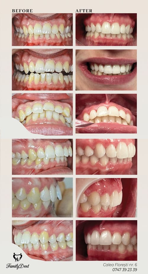 dinti inghesuiti cluj, inghesuire dentara cluj, aparat dentar fix cluj, aparat dentar cluj, aligner cluj, albire laser cluj, albire profesionala cluj
