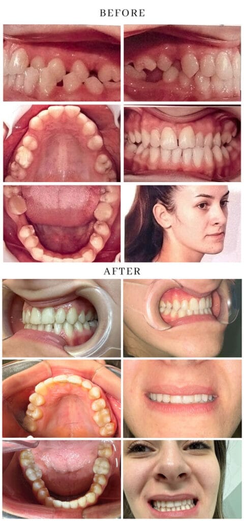 Caz ortodontic canin ieșit în afara arcadei: Rezultat înainte și după tratament cu aparat dentar fix în Cluj-Napoca