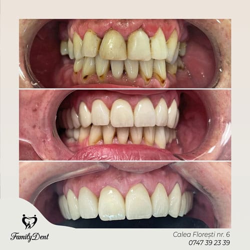 fatete dentare cluj, albire profesinala cluj, coroane dentare cluj, implant dentar cluj, stomatologie cluj