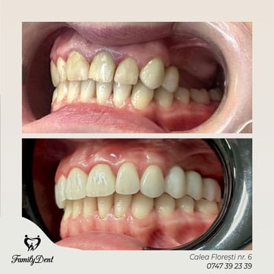mplant dentar zona frontală Cluj: Integrare perfectă a coroanei pe implant pentru un zâmbet natural.