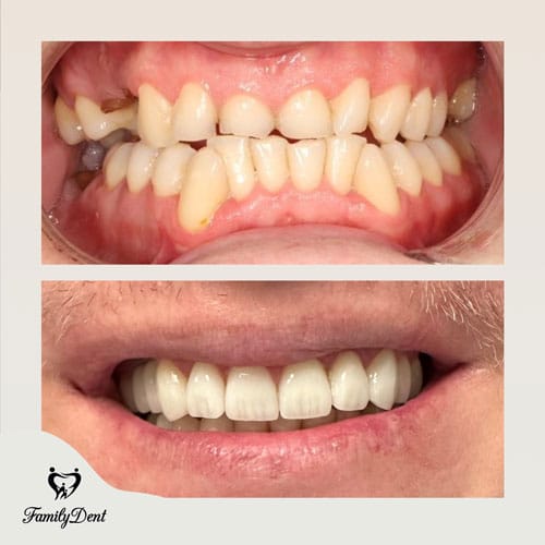 Transformare zâmbet cu aparat dentar safir: De la dinți strâmbi la o estetică naturală impecabilă