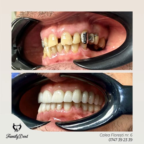 implant dentar cluj, fatete dentare cluj, coronite dentare cluj, implantologie cluj, urgente stomatologie cluj, cabinet stomatologic cluj