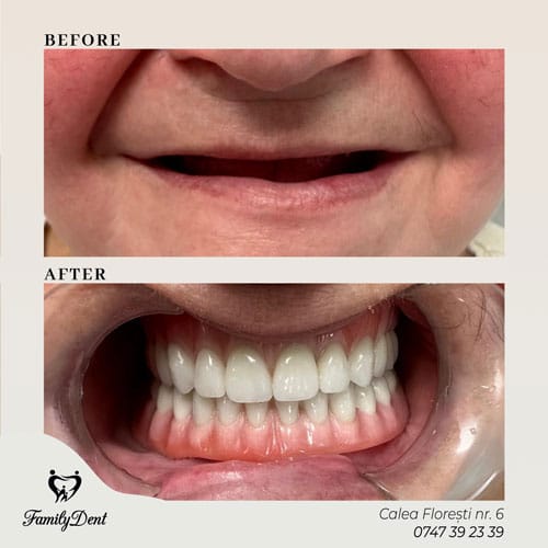 implant dentar cluj, prteza fixa cluj, edentatie totala cluj, lipsa dinti cluj, solutie proteza mobila cluj