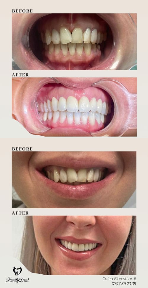 fatete dentare cluj, ortodontie cluj, aparat dentar cluj, stomatologie cluj