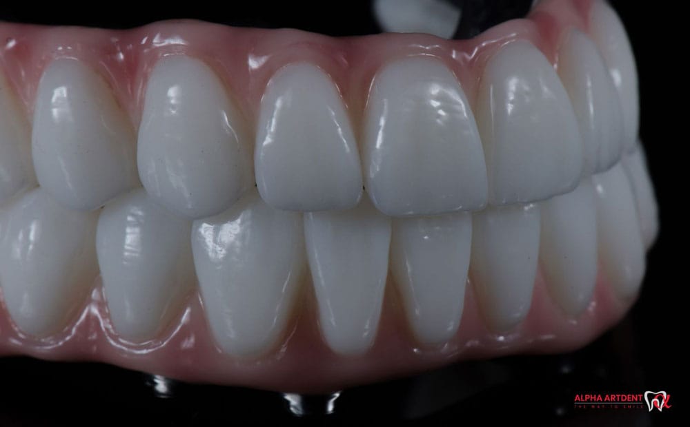 Reabilitare totala dantura All-on-4 si All-on-6 Cluj - Implanturi dentare Family Dent Cluj