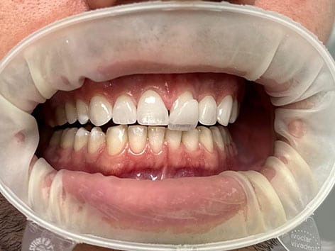 fatete dentare, coroane dentare, fatete e-max, albire dentara