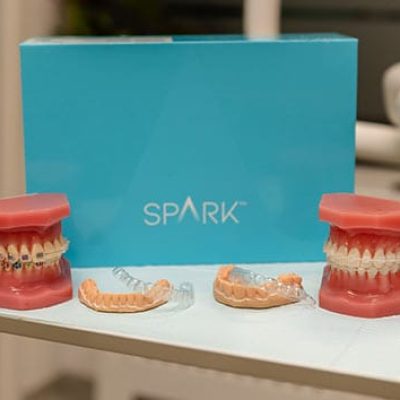 Tipuri de aparate dentare Cluj - Comparatie aparat metalic, ceramic si alignere invizibile Spark
